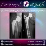 سیاه شدن سر استخوان ران و عمل جراحی تعویض مفصل لگن
