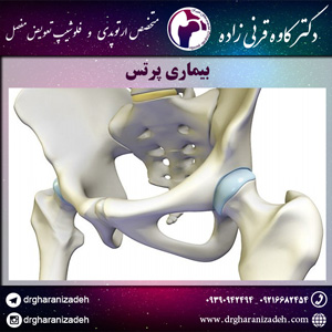 بیماری پرتس