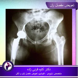 تعویض مفصل ران با کمترین میزان تهاجم