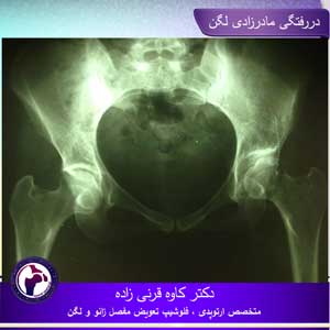 دررفتگی-مادرزادی-لگن