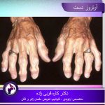 آرتروز-دست