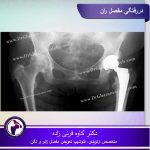 دررفتگی-مفصل-ران