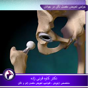 جراحی تعویض مفصل لگن در جوانان