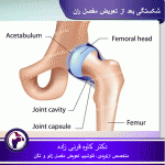 شکستگی-بعد-از-تعویض-مفصل-ران