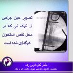 جوش نخوردگی گردن استخوان ران