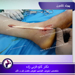پیوند-تاندون