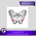 شکستگی استابولوم