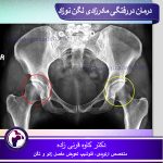 درمان دررفتگی مادرزادی لگن نوزاد