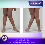 زانوی ضربدری