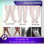 انواع-انحراف-زانو-و-درمان-آن 