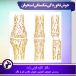 جوش نخوردگی شکستگی استخوان