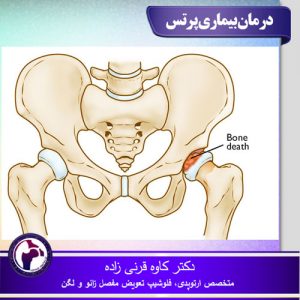 درمان بیماری پرتس