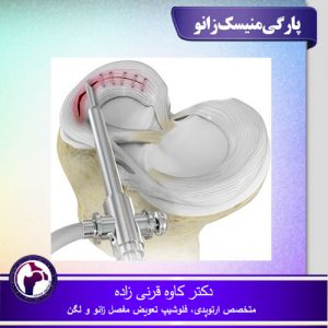 پارگی منیسک زانو