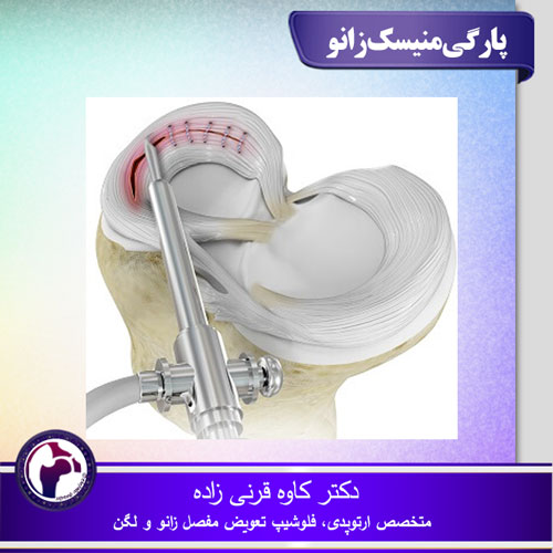 پارگی منیسک زانو