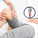 جوش خوردگی بد استخوان