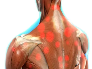 نقاط ماشه ای دردناک