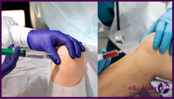 مراحل تزریق ژل برای آرتروز زانو