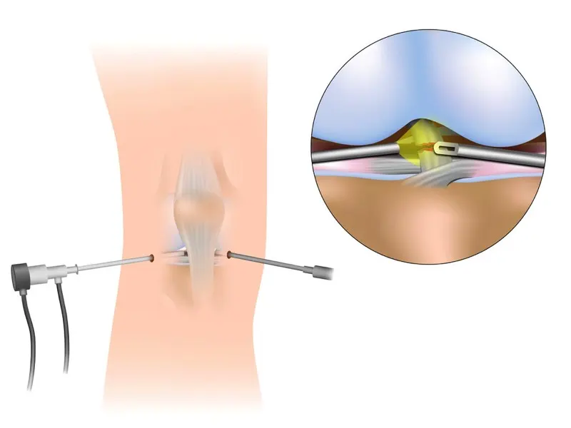 آرتروسکوپی زانو | هزینه عمل آرتروسکوپی زانو | قیمت آرتروسکوپی زانو