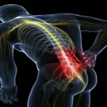 علت درد لگن بعد از عمل دیسک کمر - دکتر کاوه قرنی زاده