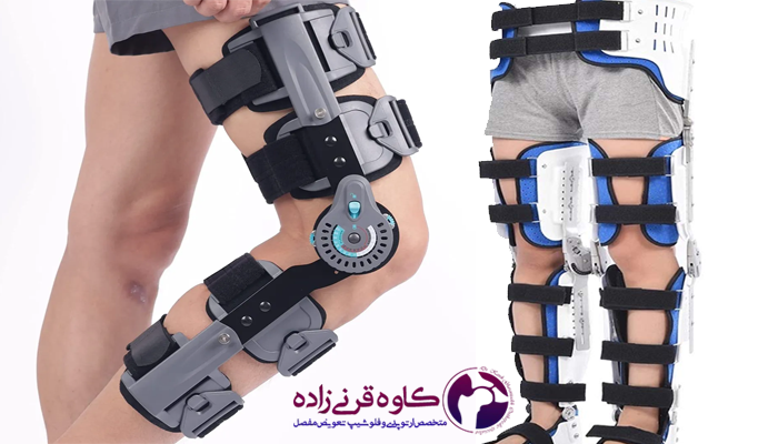  نتایج استفاده از بریس زانو پرانتزی