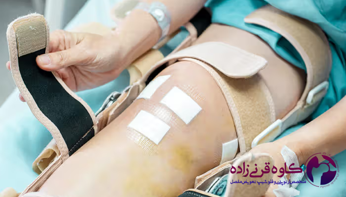 مراقبت های طولانی مدت بعد از تعویض مفصل زانو