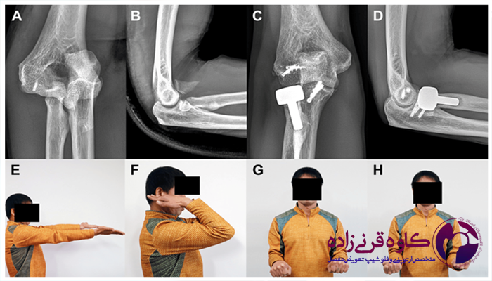 سه گانه وحشتناک آرنج