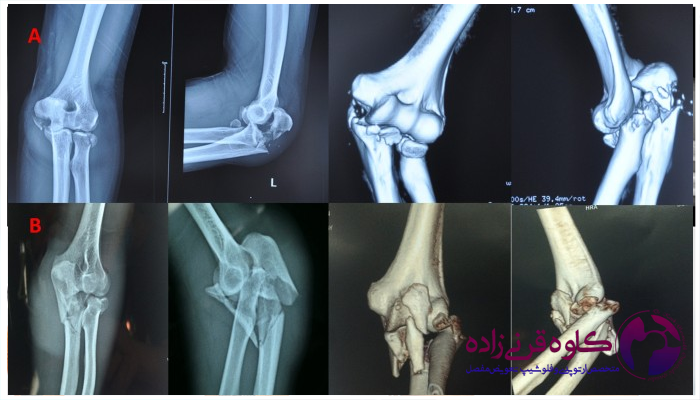 چالش های درمان سه گانه وحشتناک آرنج