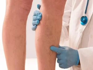 ورم پا بعد از عمل تعویض مفصل لگن - دکتر قرنی زاده