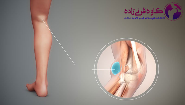 علائم کیست مینیسک زانو