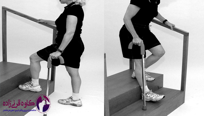 مدل راه رفتن بعد از تعویض مفصل زانو