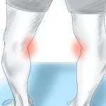 جراحی پای پرانتزی یا استئوتومی - دکتر کاوه قرنی زاده
