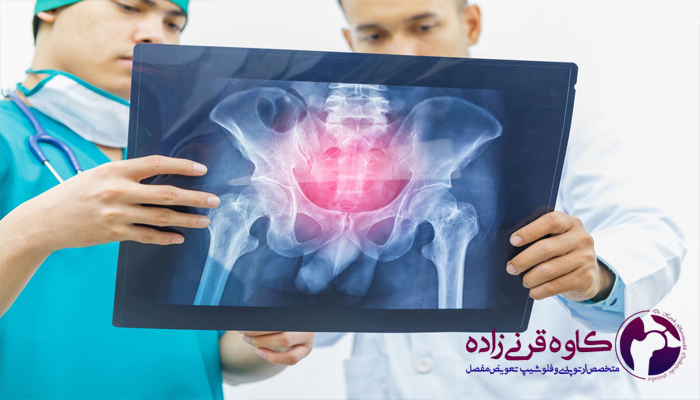 انواع سرطان استخوان لگن