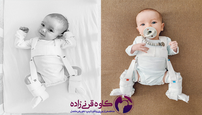 بستن کمربند پاولیک هارنس