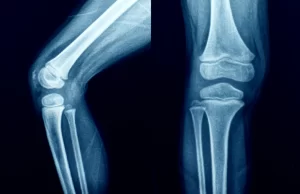 خار زانو - دکتر کاوه قرنی زاده