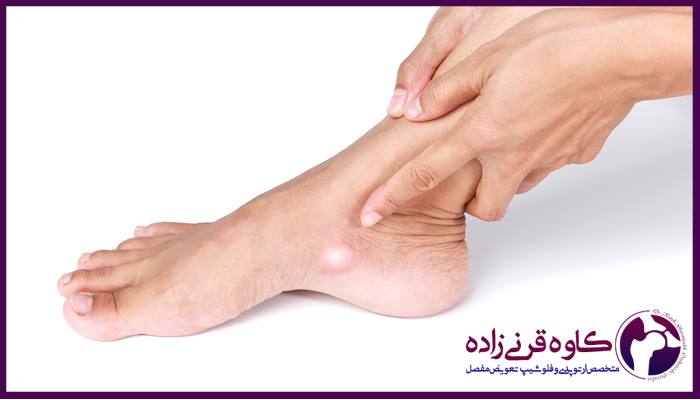 برآمدگی استخوان روی پا