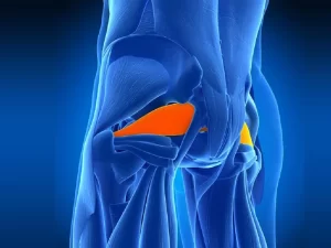 سندروم پیریفورمیس یا سندرم عضله گلابی - دکتر کاوه قرنی زاده