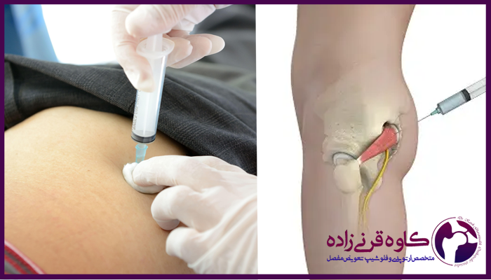 تزریق در عضله پیریفورمیس