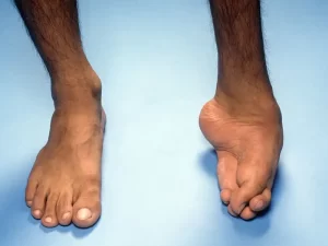 کلاب فوت یا پاچنبری - دکتر کاوه قرنی زاده