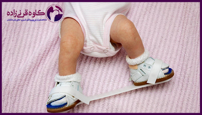 درمان کلاب فوت یا پاچنبری