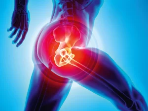 بهترین سن برای تعویض مفصل لگن - دکتر کاوه قرنی زاده