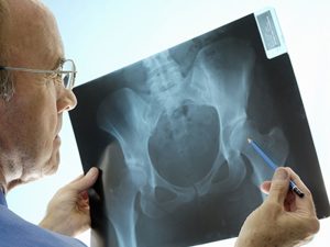 درمان نکروز آواسکولار بدون جراحی - دکتر کاوه قرنی زاده