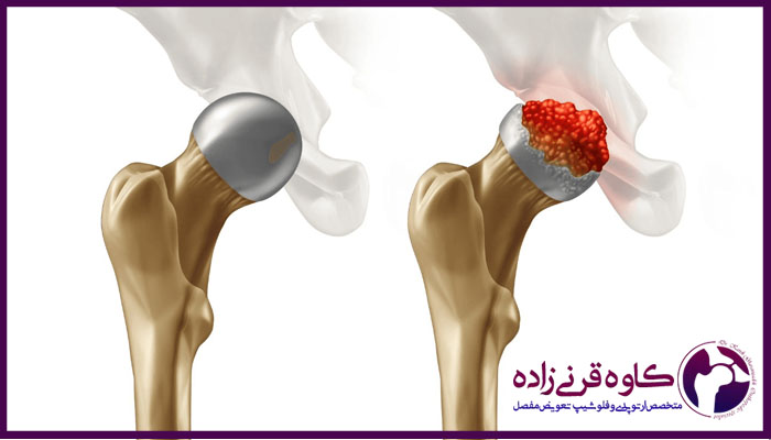 تکنیک های درمان نکروز آواسکولار بدون جراحی 