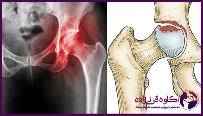 پیشرفت نکروز لگن
