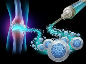 درمان آرتروز با سلول بنیادی - دکتر کاوه قرنی زاده