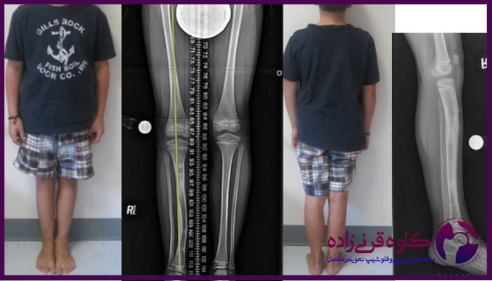کوتاهی پا در کودکان